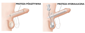 zaburzenia erekcji - proteza prącia